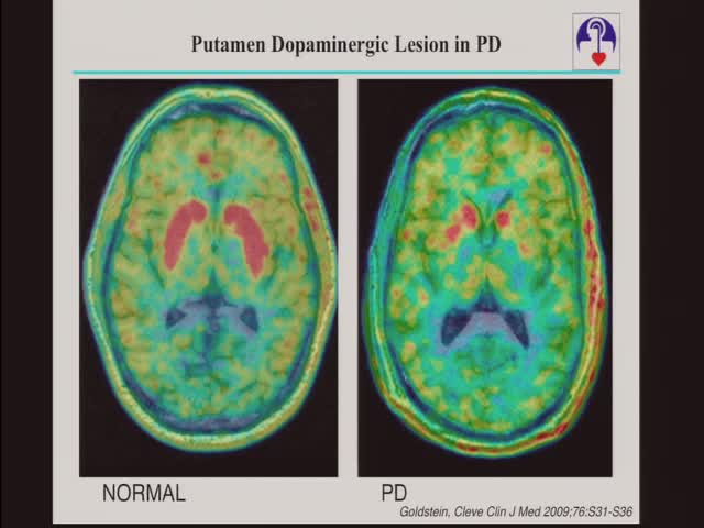 Putamen Dopaminergic Lesion in PD