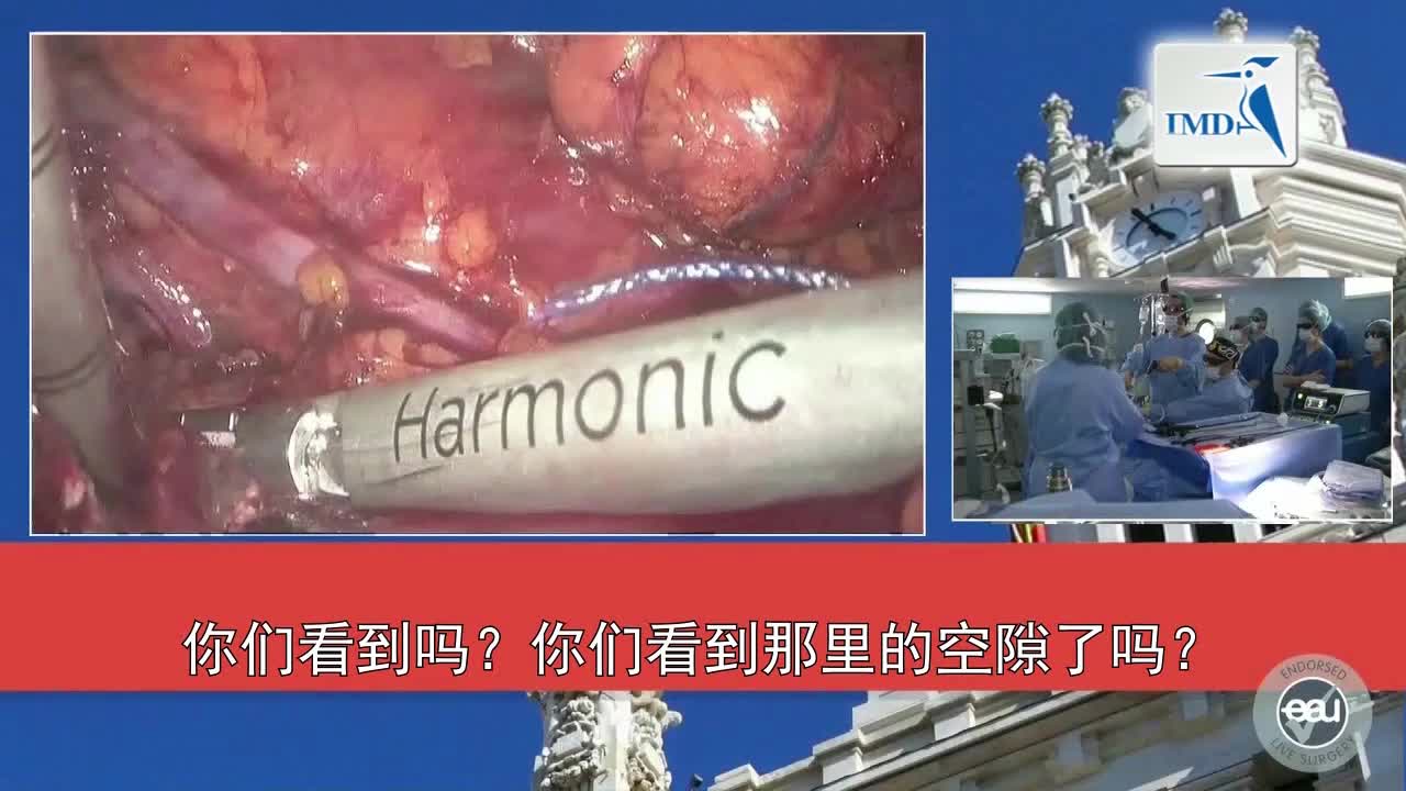 3D高清SPIES辅助腹腔镜部分肾切除术（3）