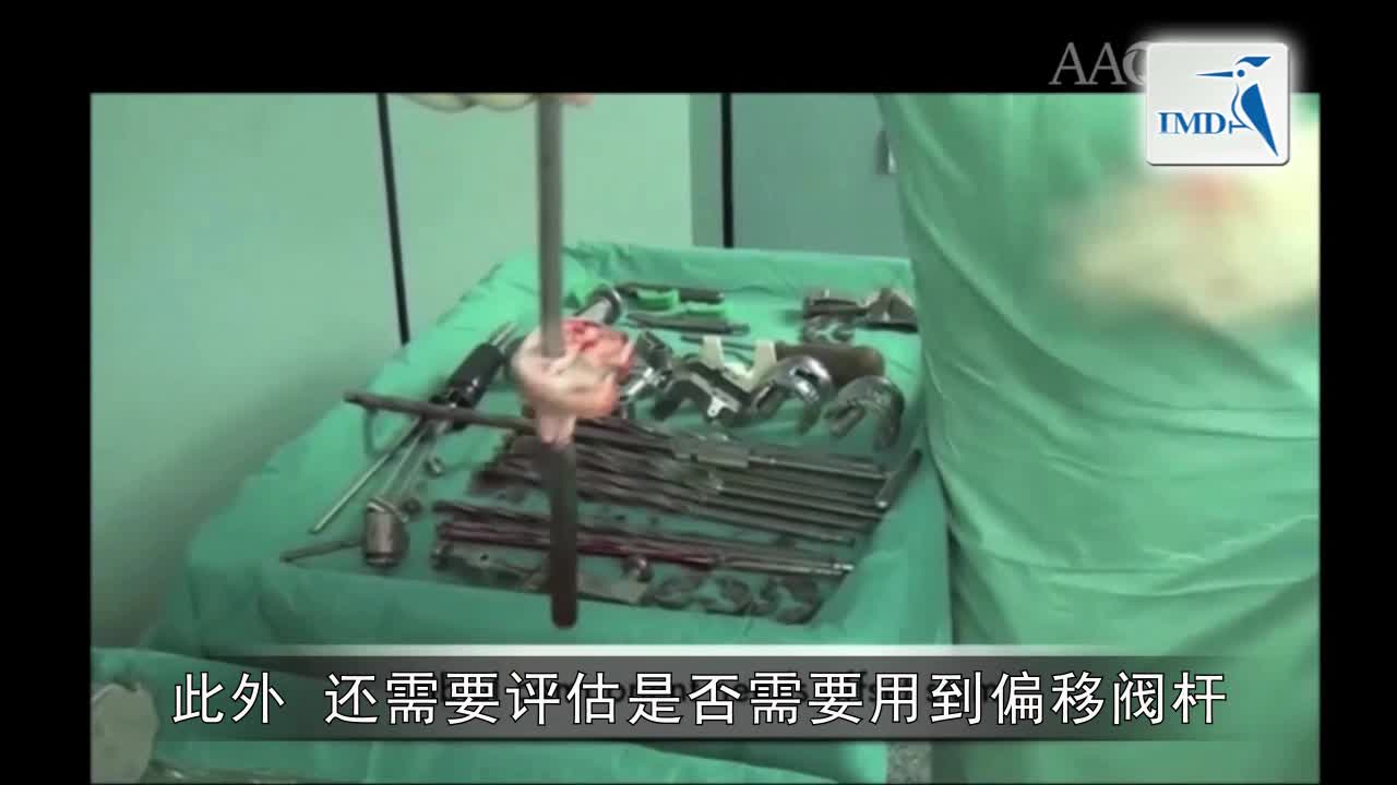 全膝关节置换术中的三步骤技巧（2）