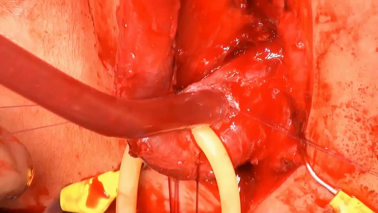 Non-transecting anastomotic urethroplasty is a new type o..-