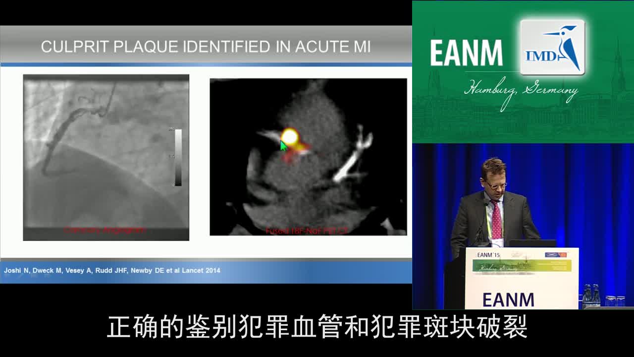 动脉粥样硬化：成像，从转化临床（4）