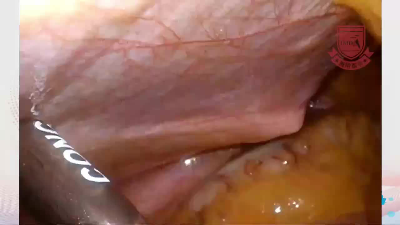 焦剑-微腹腔镜直肠癌根治术（超低位保肛）