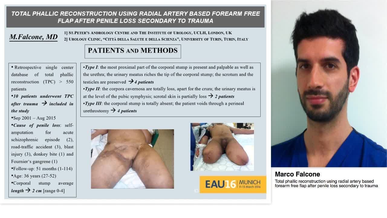 Total phallic reconstruction using radial artery based fo-