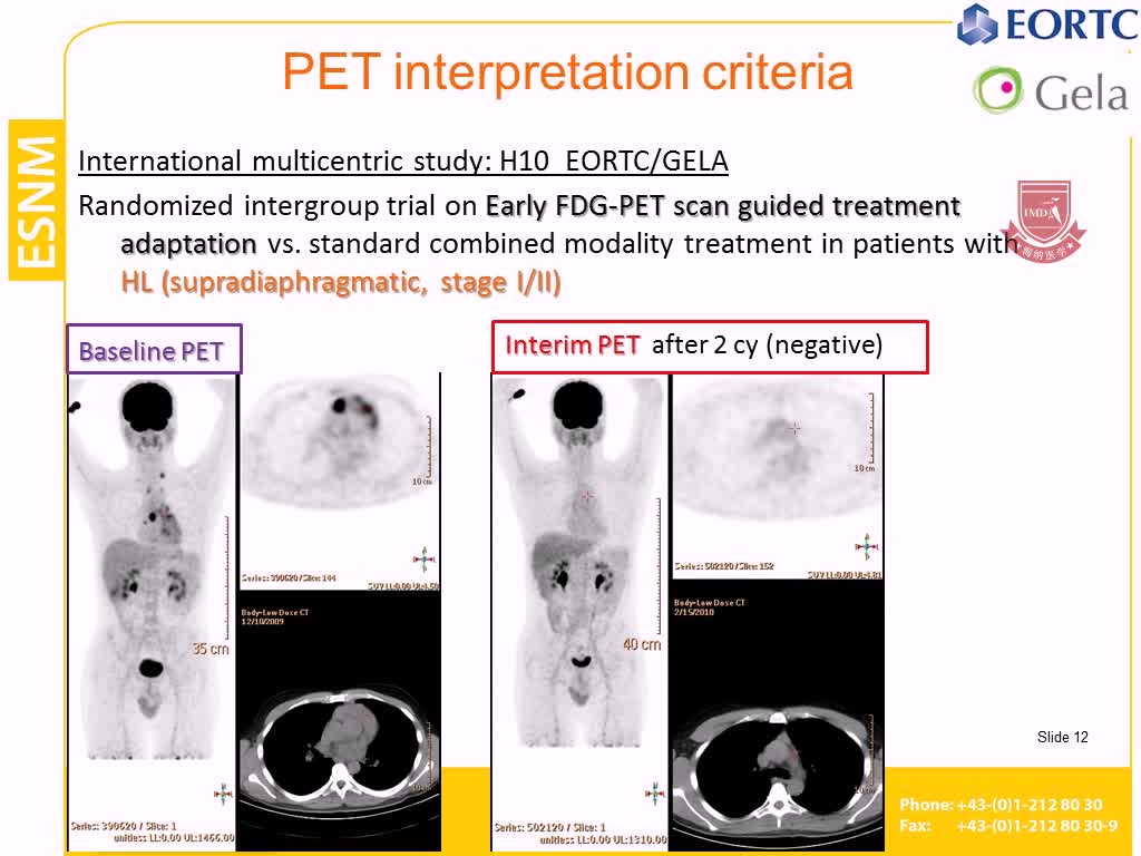 PET CT用于淋巴瘤2