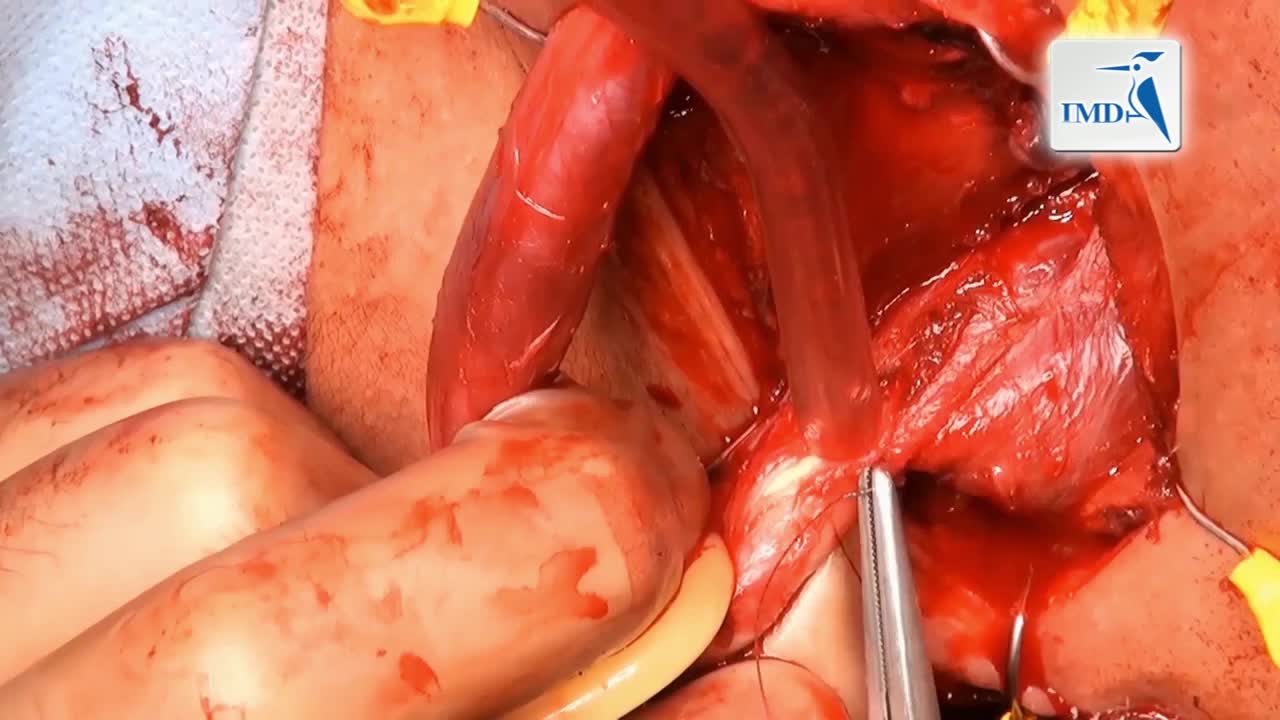 非横断尿道吻合术