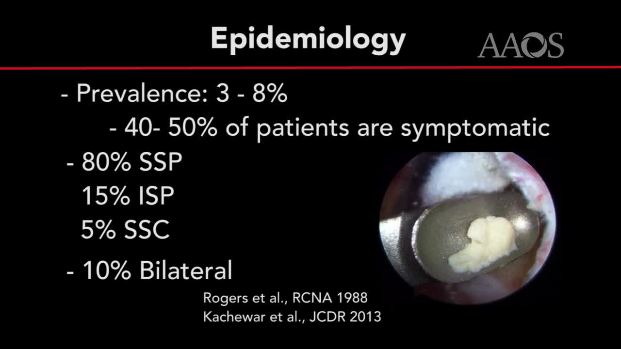 Arthroscopic Treatment of Calcific Tendonitis of the Rotator Cuff