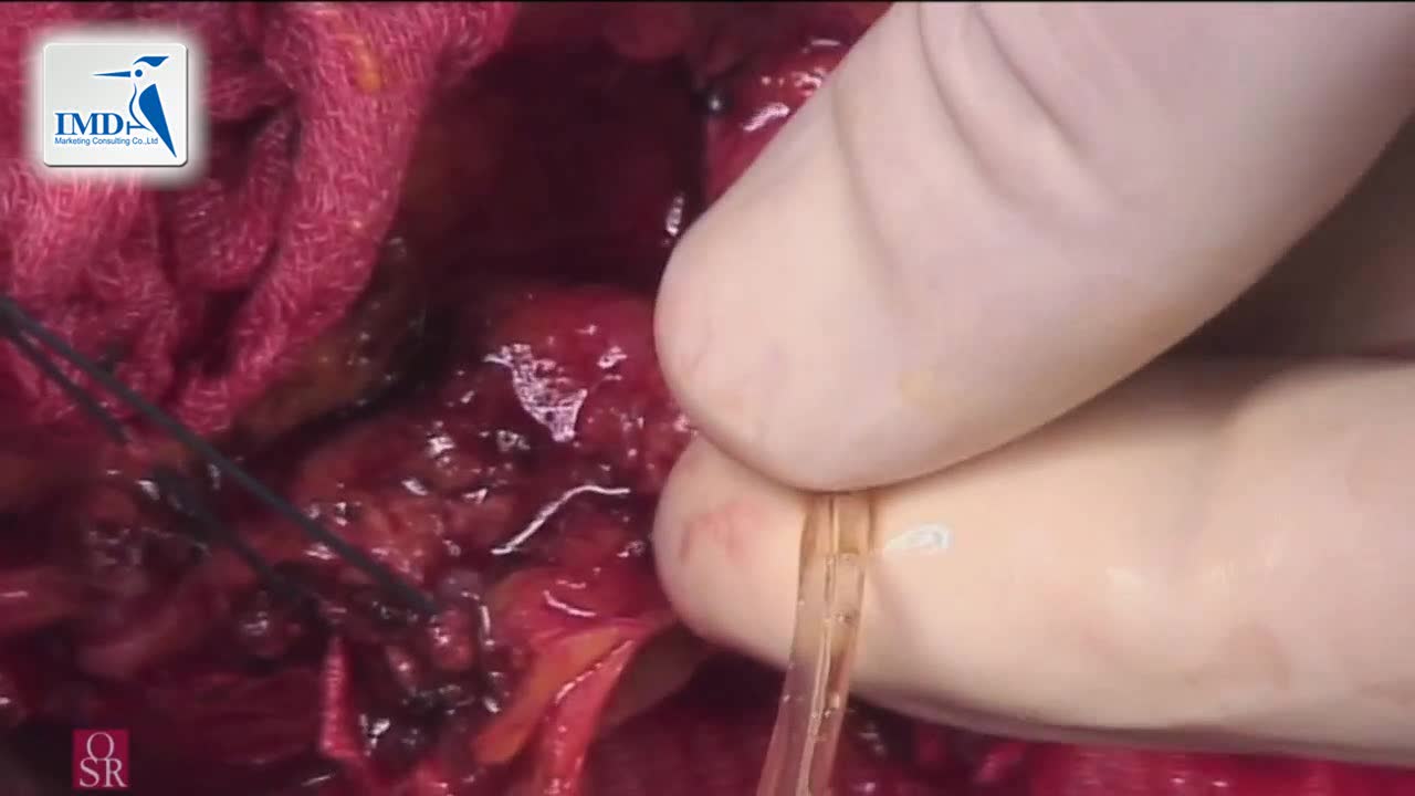 10胸腹部主动脉瘤开放性修复术