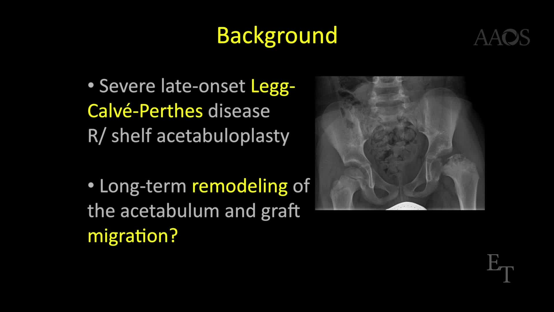 Modified Shelf Acetabuloplasty Surgical Technique & Case Series
