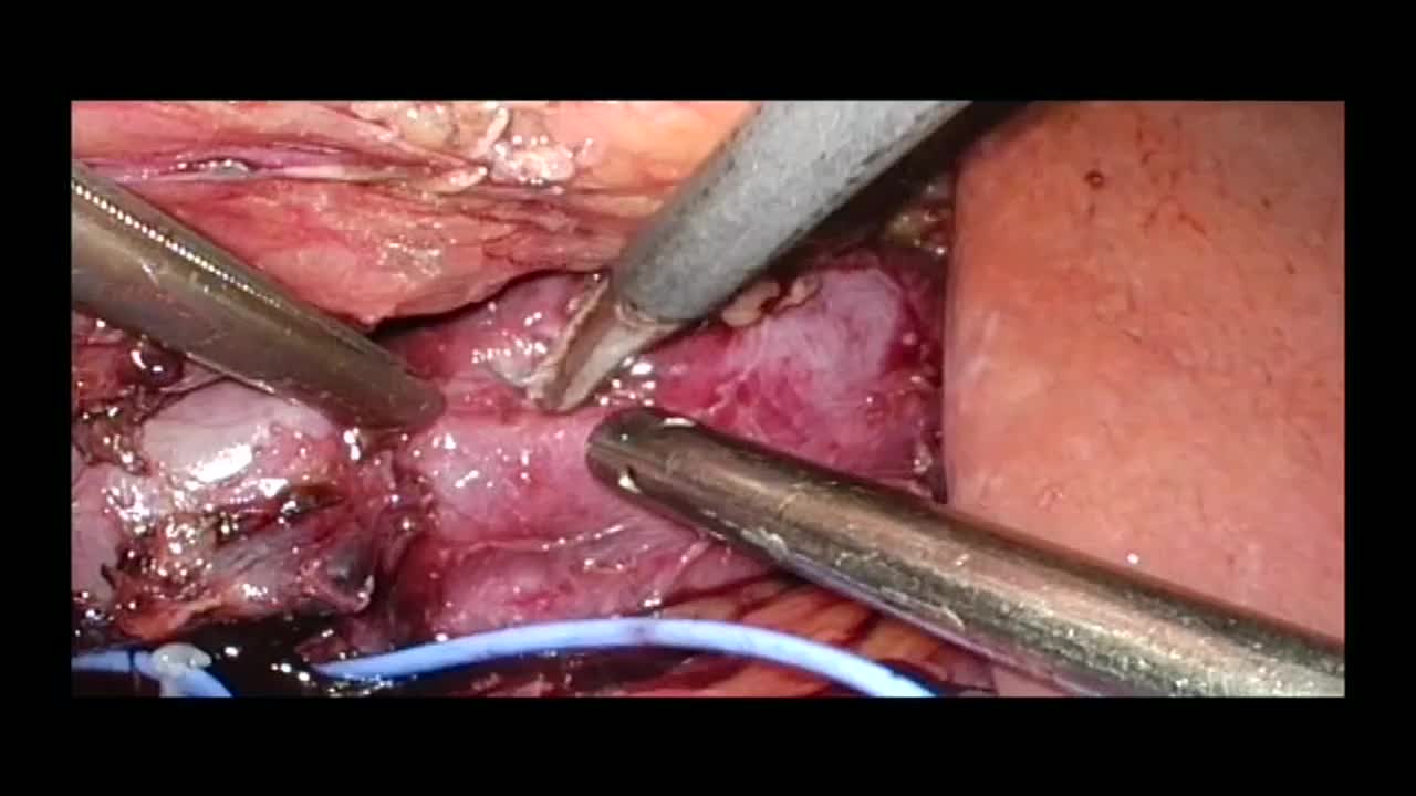 Our experience of laparoscopic thrombectomy and vena cava..-