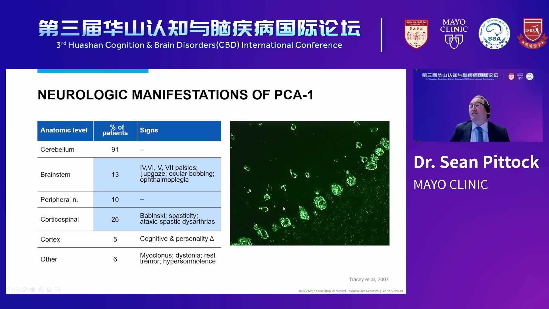 Autoimmune  Paraneoplastic Neurologic Disorders-Dr.Sean Pittock 3