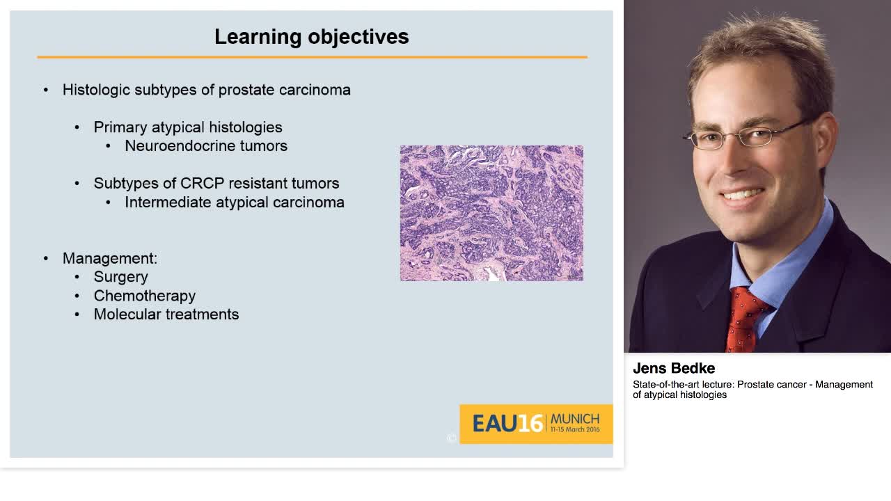 Prostate cancer - Management of atypical histologies