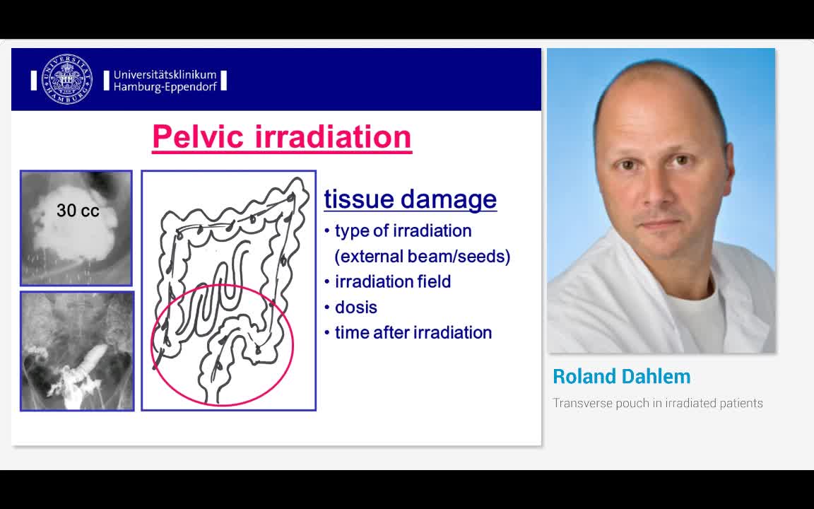Transverse pouch in irradiated patients