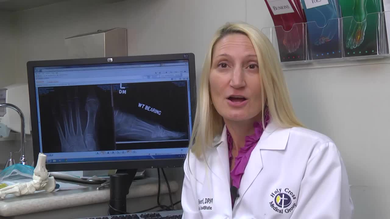 大脚趾关节炎的诊断和治疗-- Dr. Jennifer Boeri 圣十字医院脚&关节外科医生