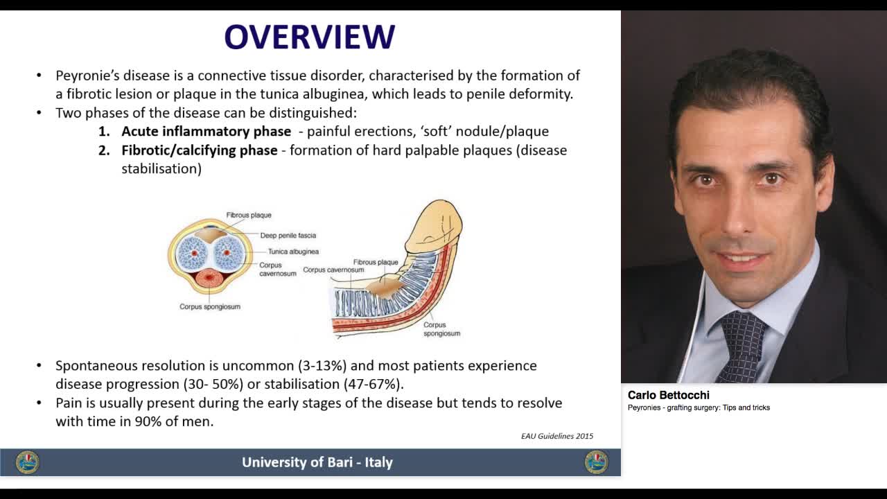Peyronies - grafting surgery, Tips and tricks