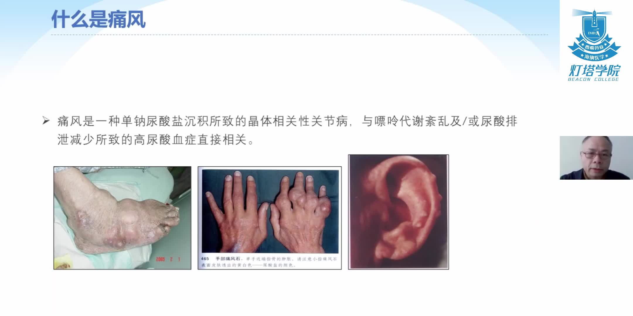 痛风性关节炎的临床表现