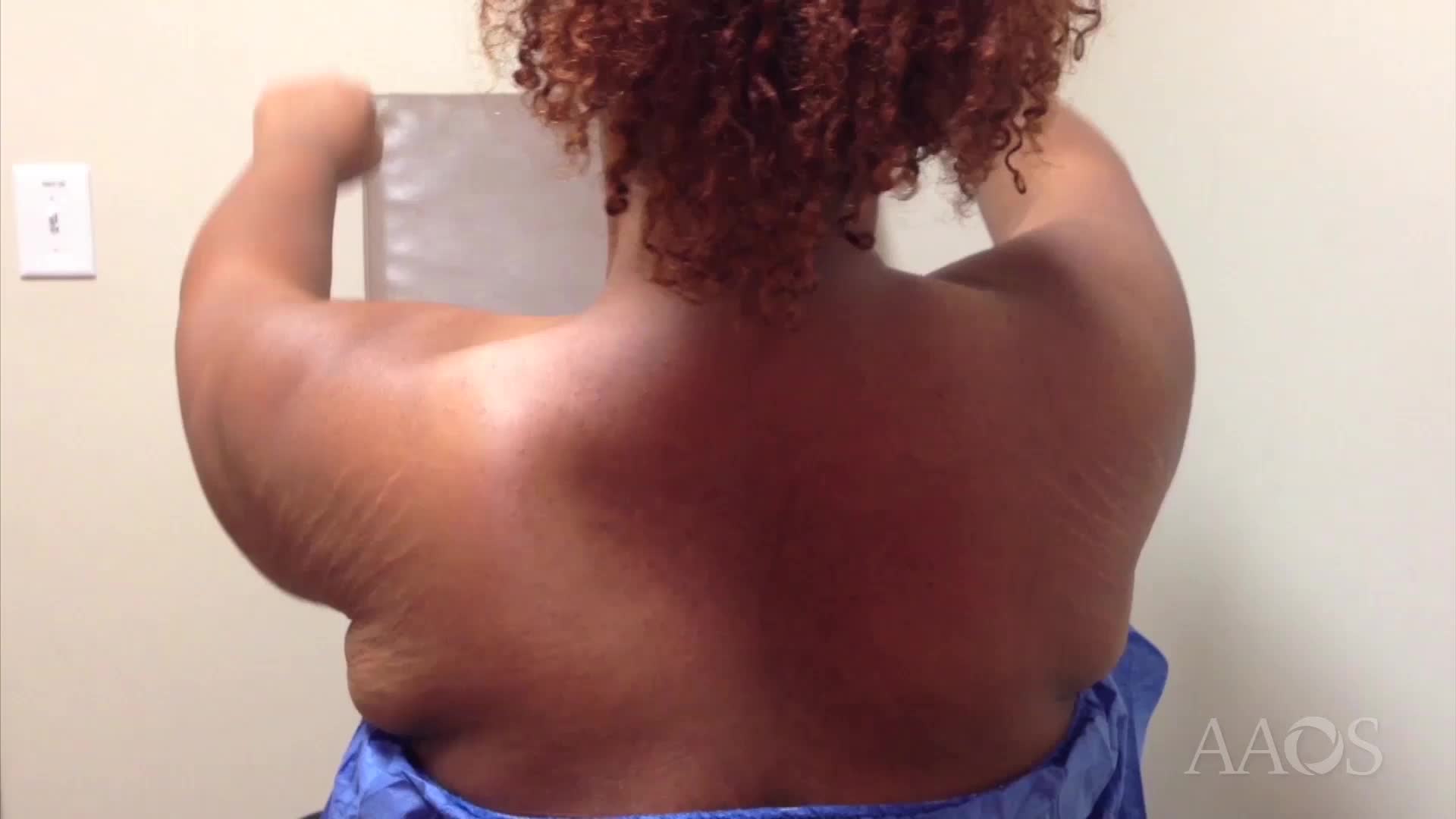 Eden Lange Transfer for Trapezius Palsy