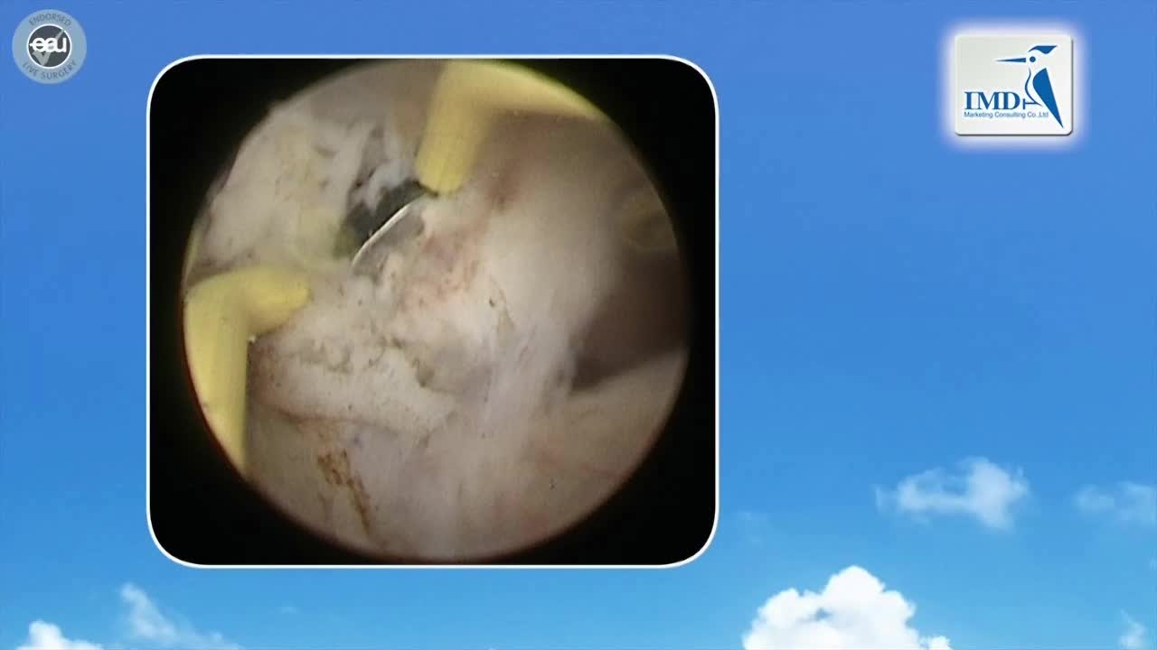 经尿道双极前列腺剜除术（4）