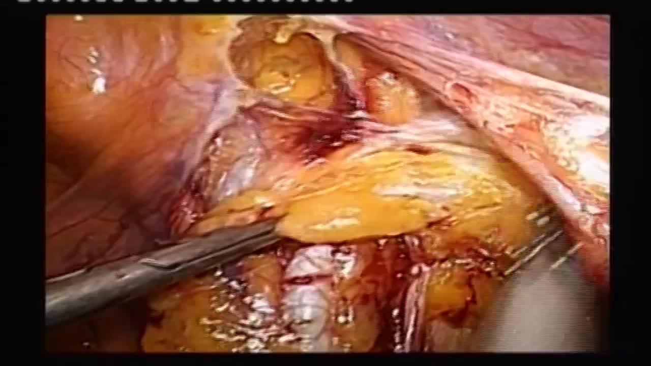 Laparoscopic radical prostatectomy with extended lymphade..-
