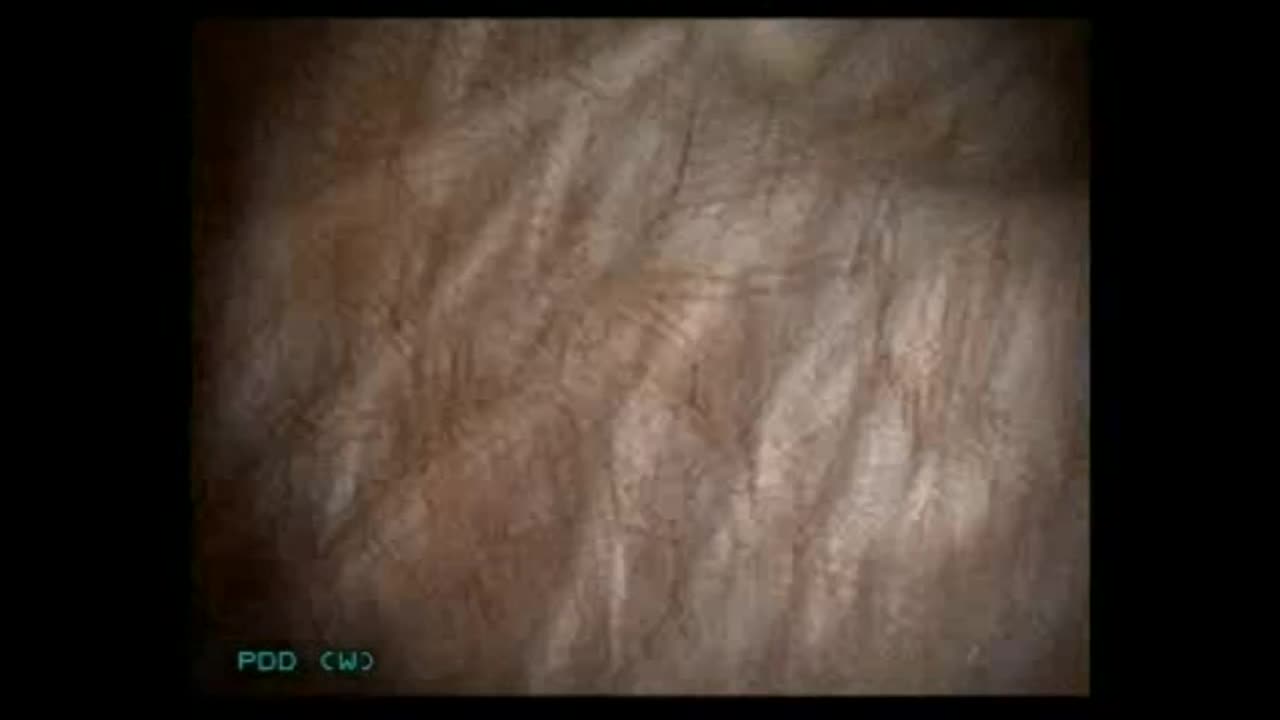 Blue light flexible cystoscopy in bladder cancer in an ou..-