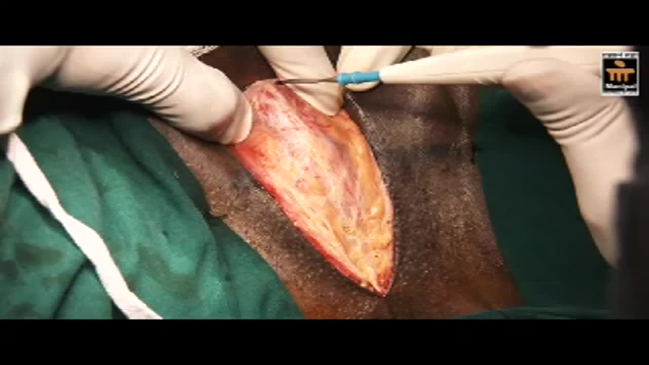 V14 - Double buccal graft in non traumatic bulbar urethral stri..-