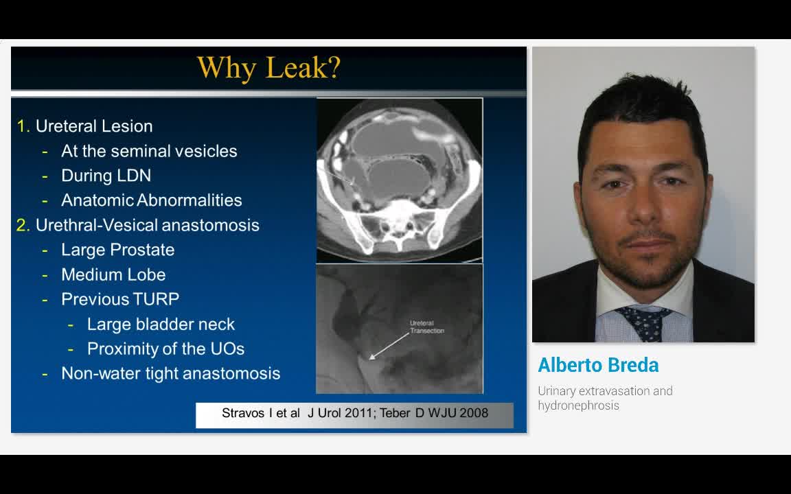 Urinary extravasation and hydronephrosis