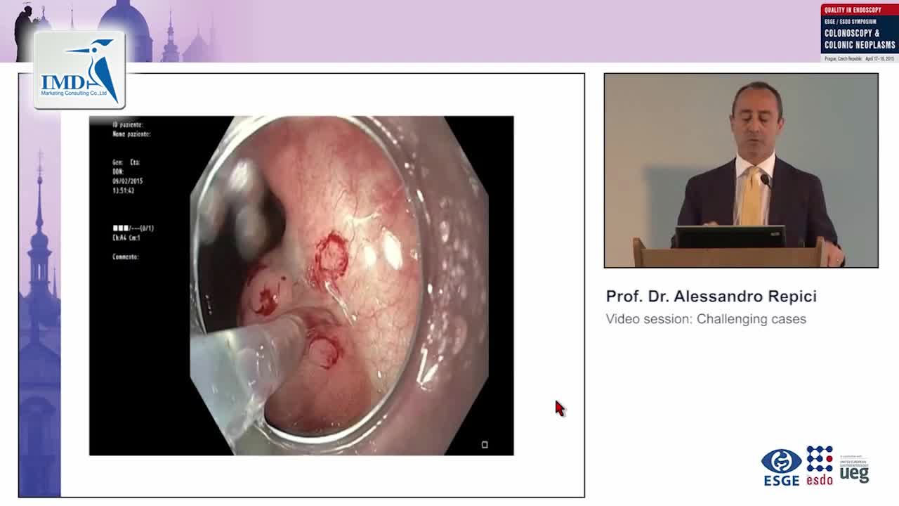 息肉切除术的挑战（4）