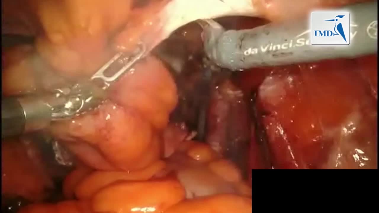 机器人辅助切除部分膀胱手术