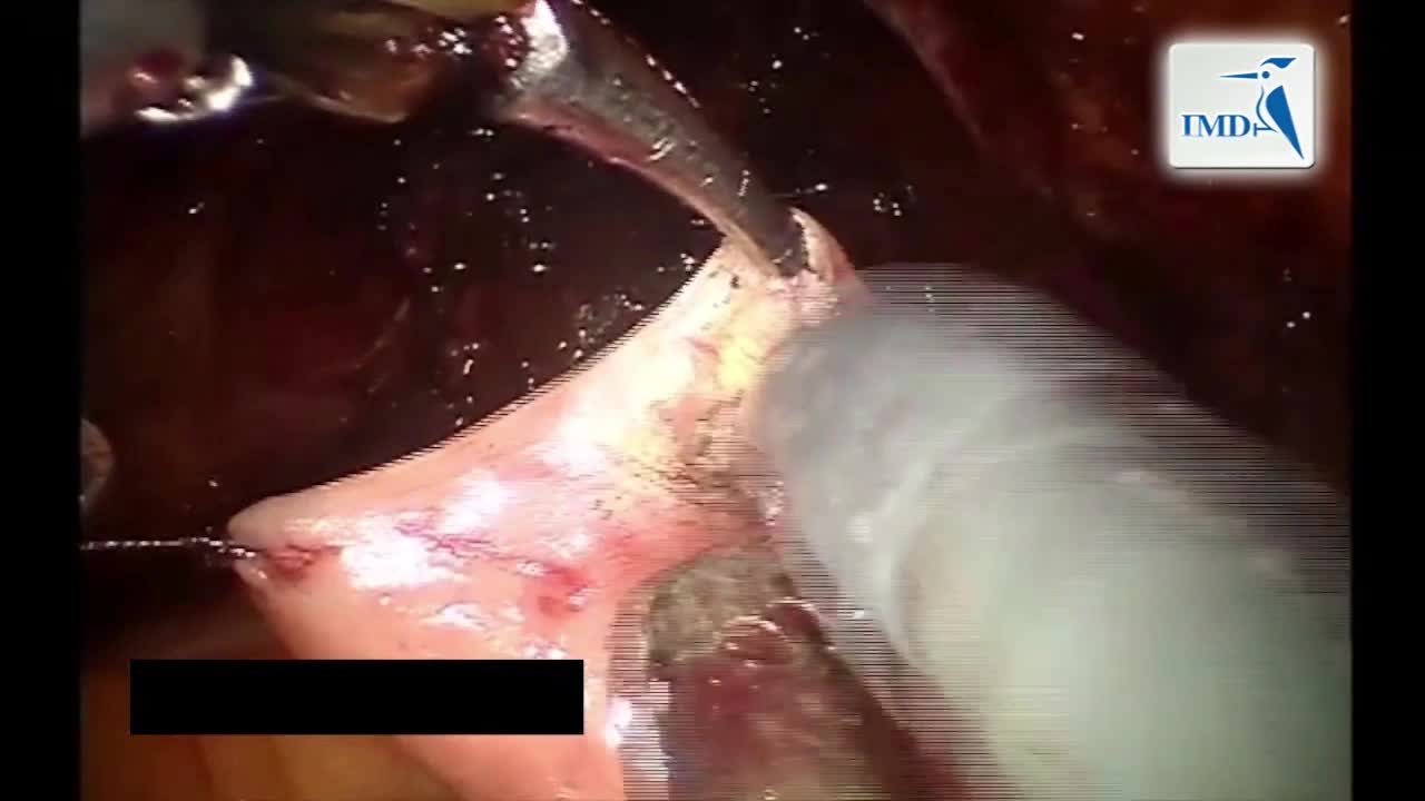 机器人膀胱全切除原位新膀胱术