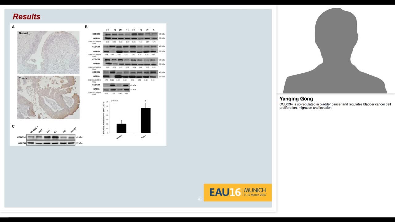 CCDC34 is up-regulated in bladder cancer and regulates bl-