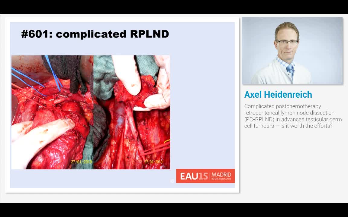 Complicated postchemotherapy retroperitoneal lymph node d..-