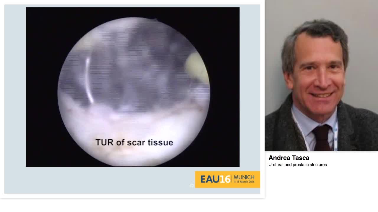 Urethral and prostatic strictures
