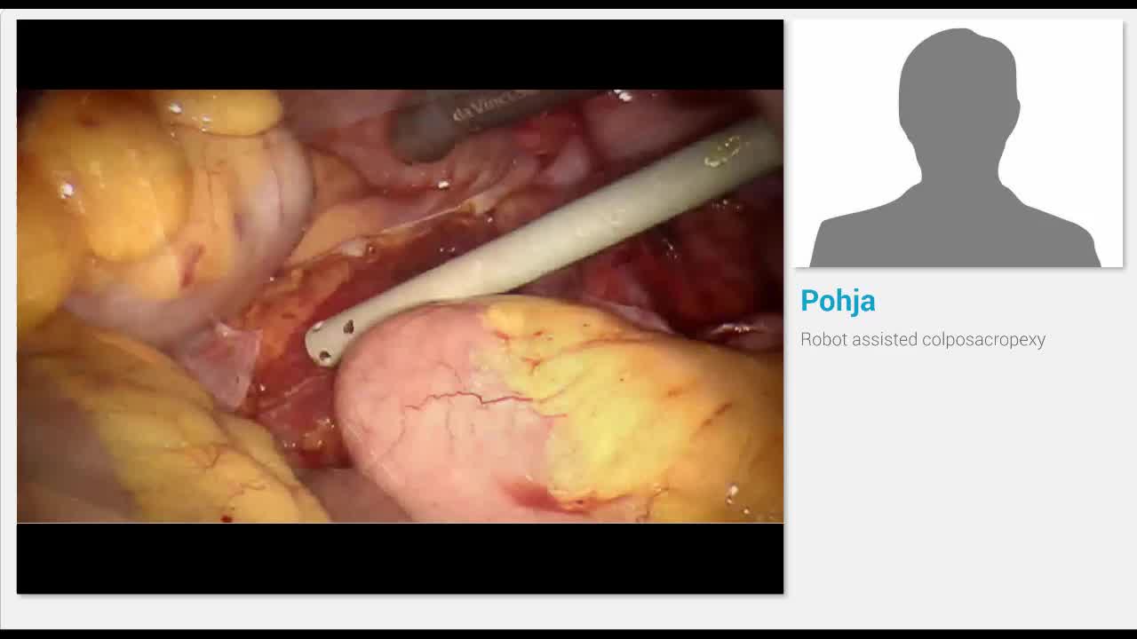 Robot assisted colposacropexy