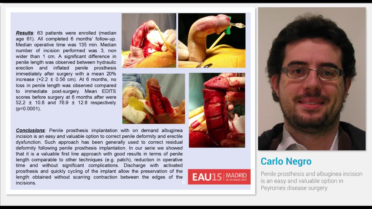 Penile prosthesis and albuginea incision is an easy and v..-