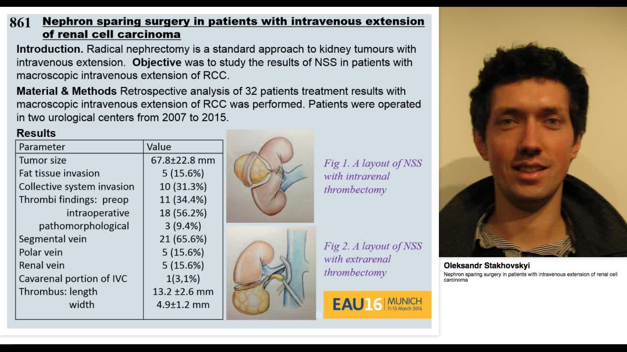 Nephron sparing surgery in patients with intravenous exte-