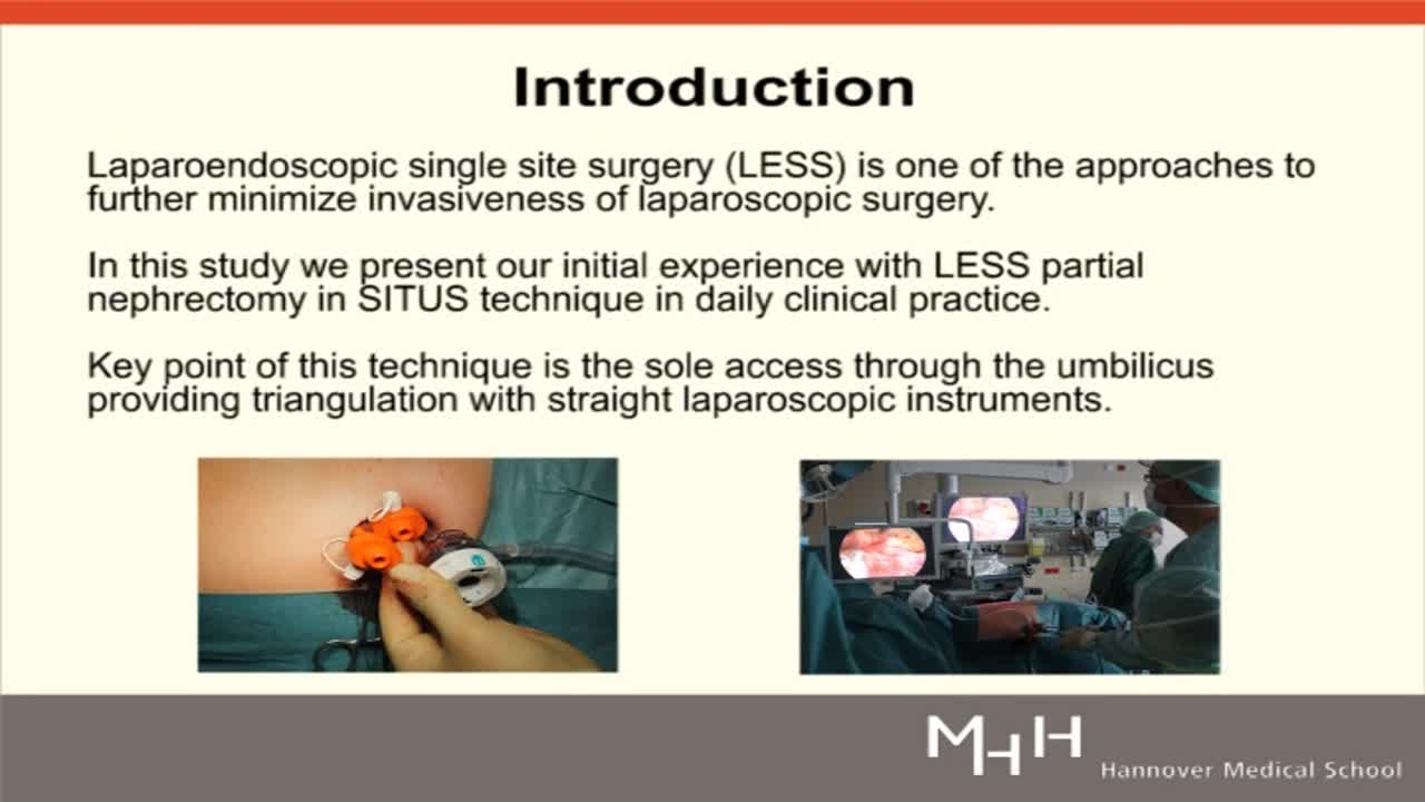 Laparoendoscopic single incision triangulated umbilical s..-