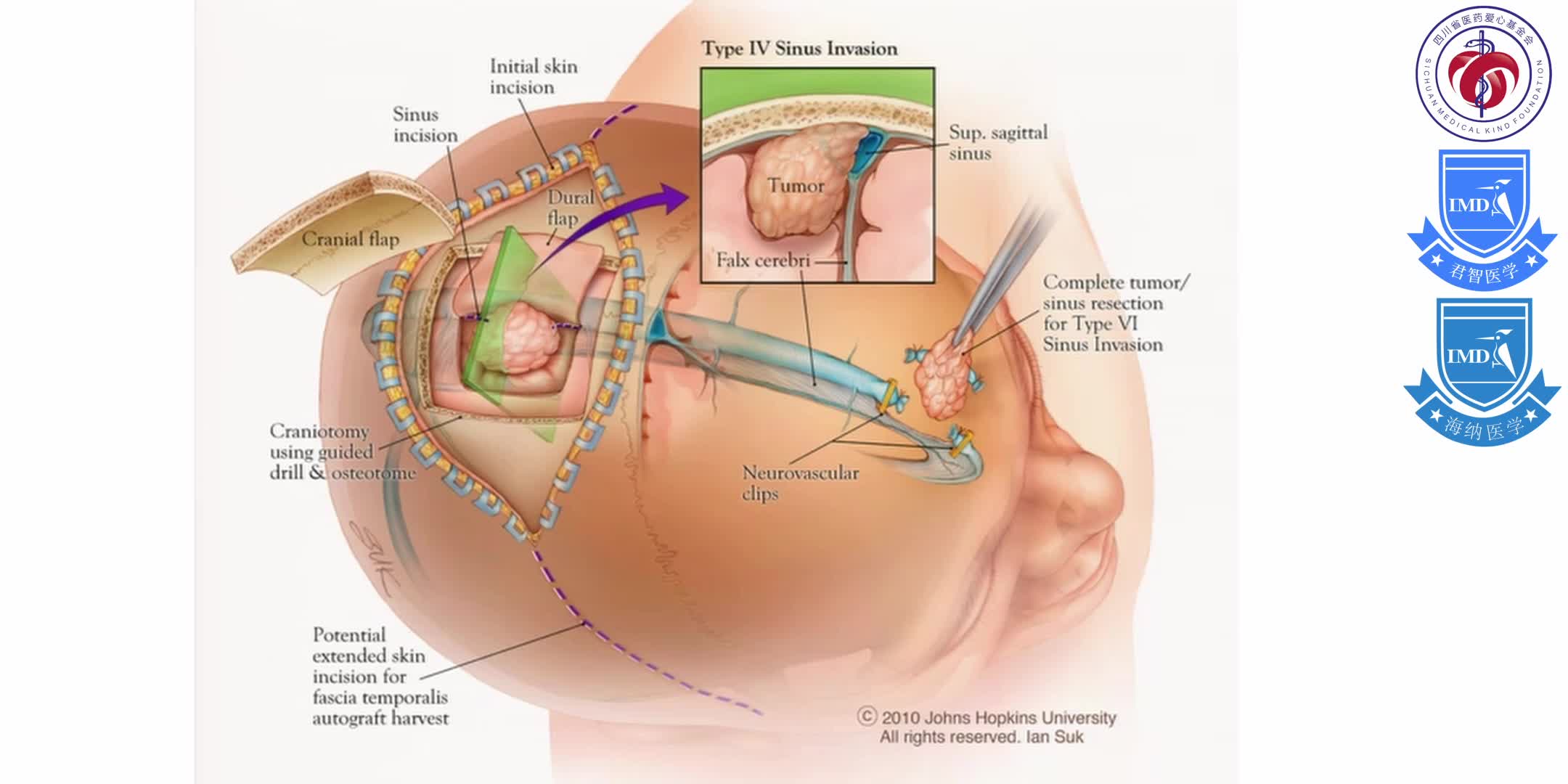 Initial Treatment, Including Scenarios Requiring Urgent and Multi-disciplinary Management for Primary Brain Tumors 12