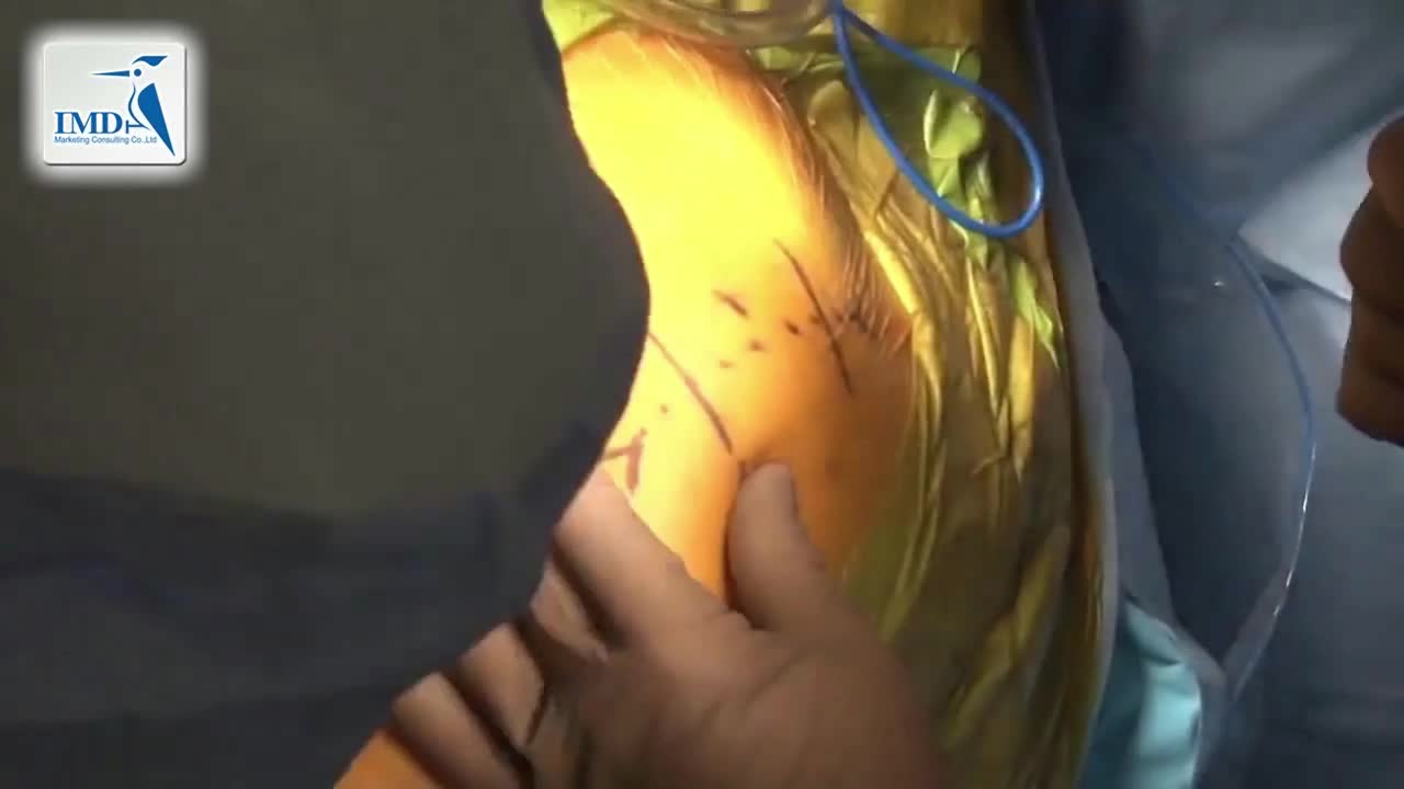 后入路髋关节微创手术（1）