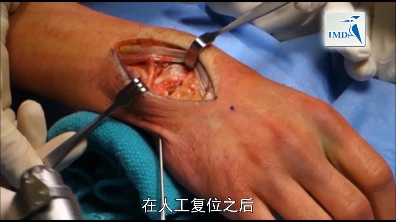 经舟骨月骨周围骨折脱位：手术技巧（2）