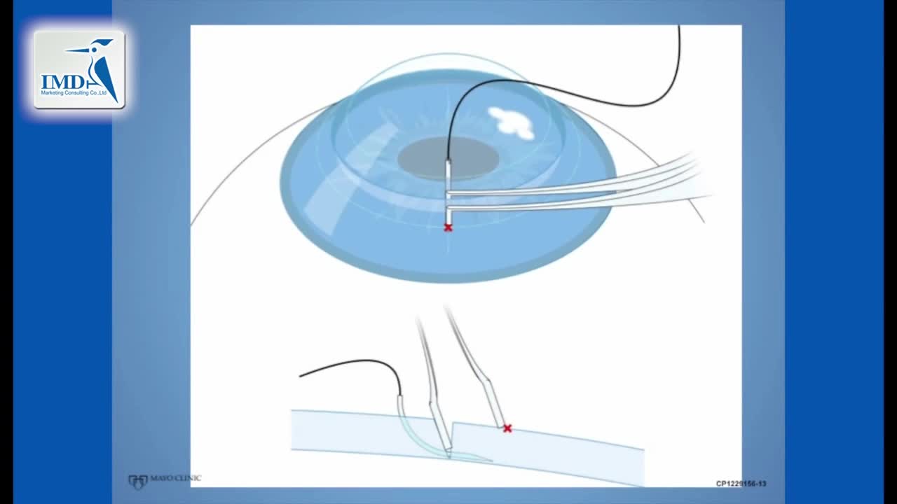 角膜缝合手术操作步骤（3）