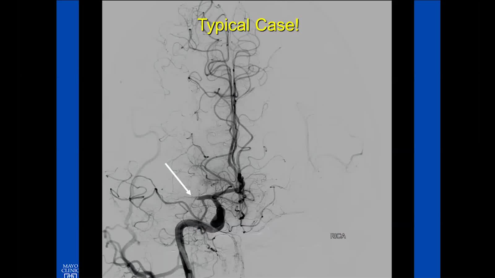 2-2 具有挑战性的急性缺血性卒中案例-Rabih Tawk