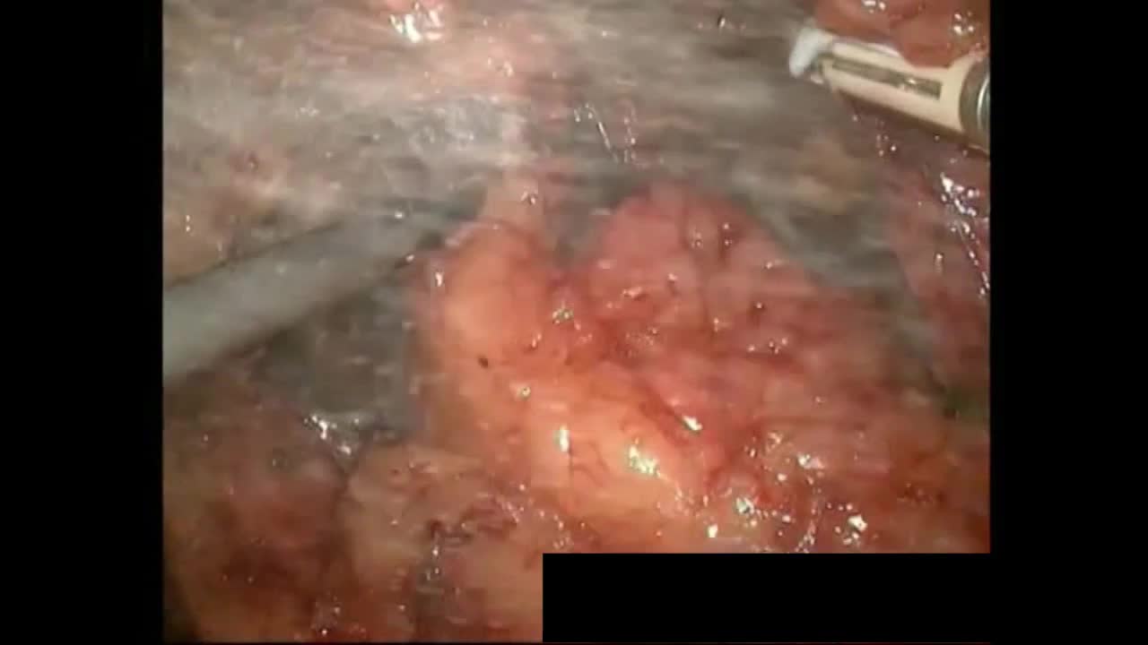 A novel technique during laparoscopic partial nephrectomy