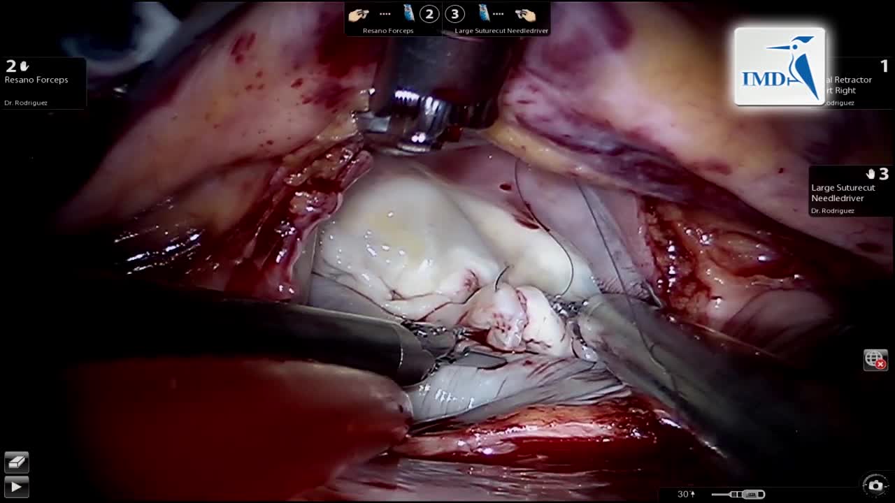二尖瓣修补术（2）