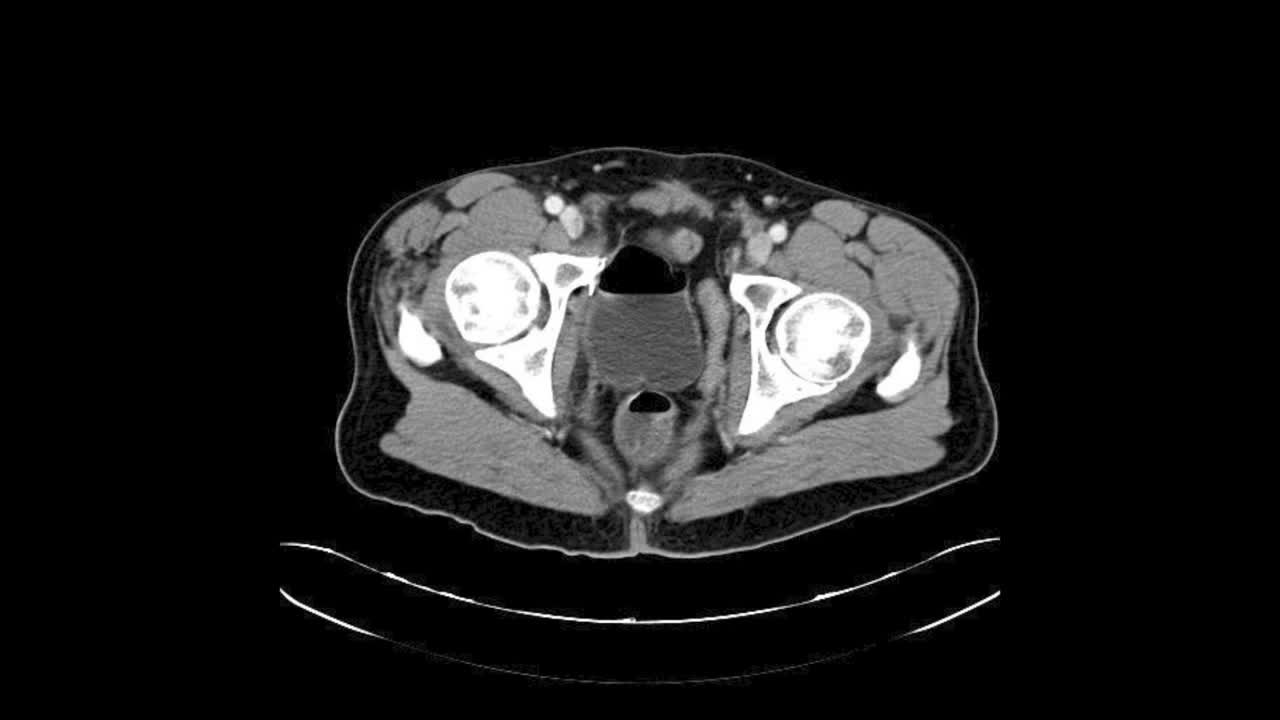 Reparation of a rectal-neobladder fistula with fistulecto..-