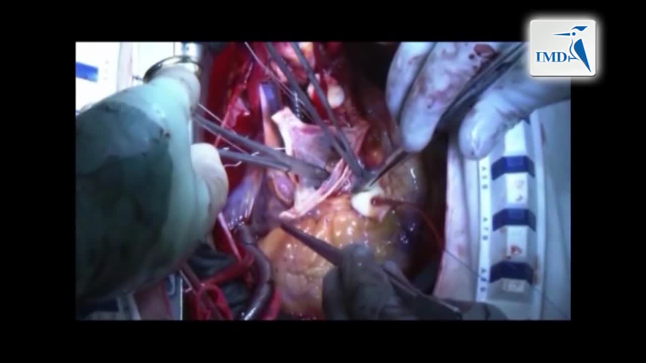 保留瓣膜的主动脉根部置换术（2）