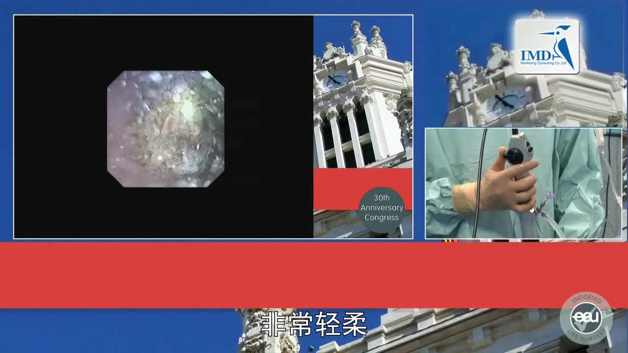 SPIES辅助逆向输尿管软镜诊断治疗上尿路结石（4）