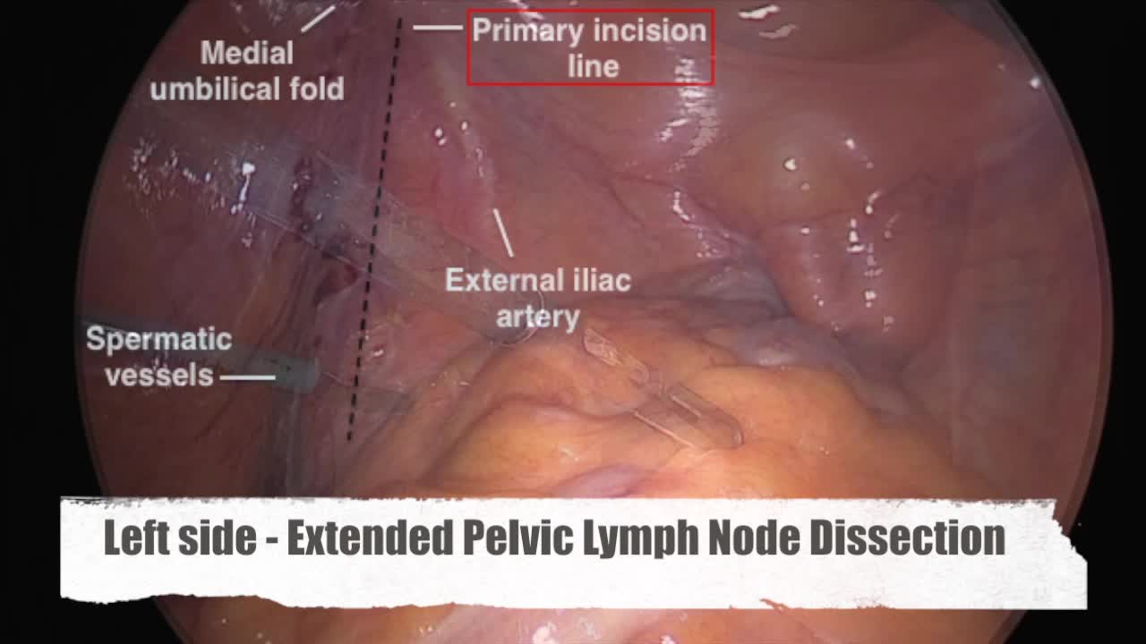 Laparoscopic radical prostatectomy in intermediate and hi..-