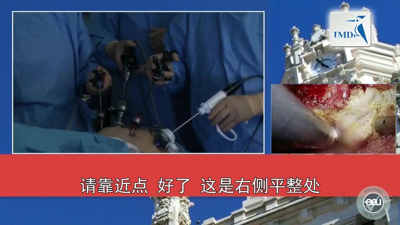 3D腹腔镜腹膜外根治性前列腺切除手术（2）