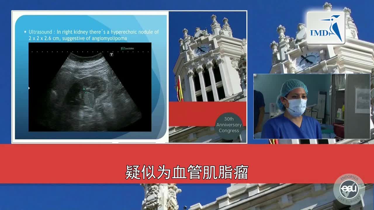 3D高清SPIES辅助腹腔镜部分肾切除术（1）