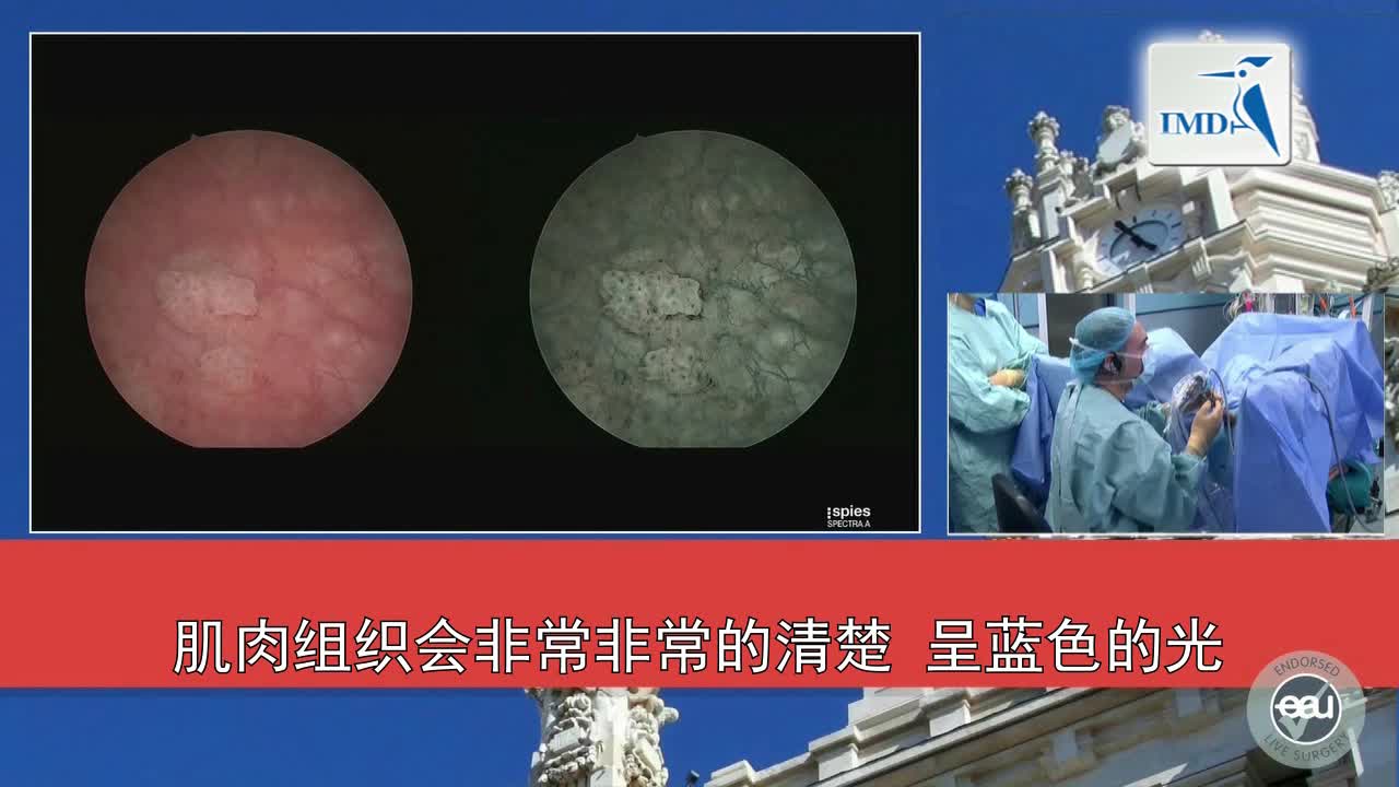 经尿道膀胱肿瘤切除手术（2）