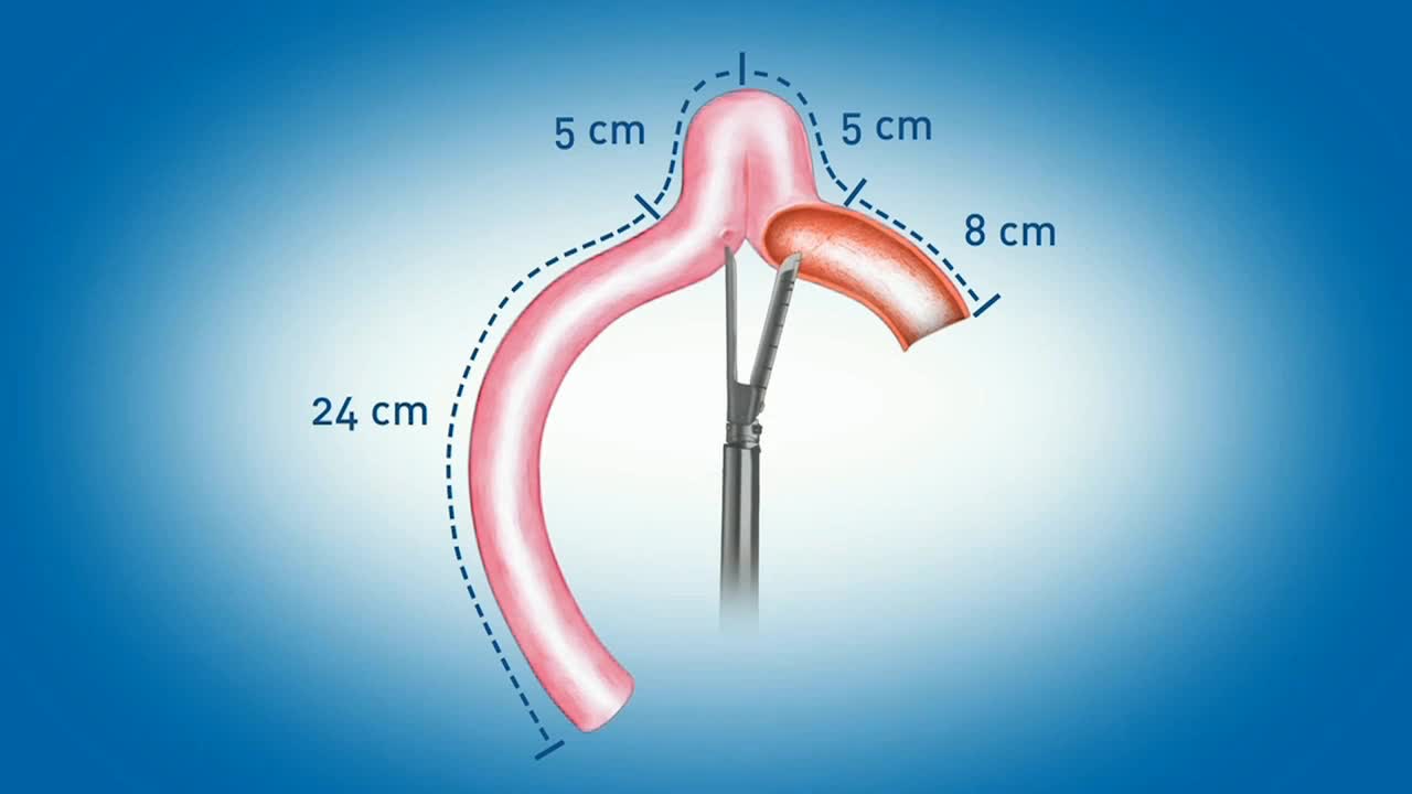 Totally intracorporeal robot-assisted vescica ileale Pado..-
